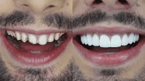 Antes e Depois Dentição